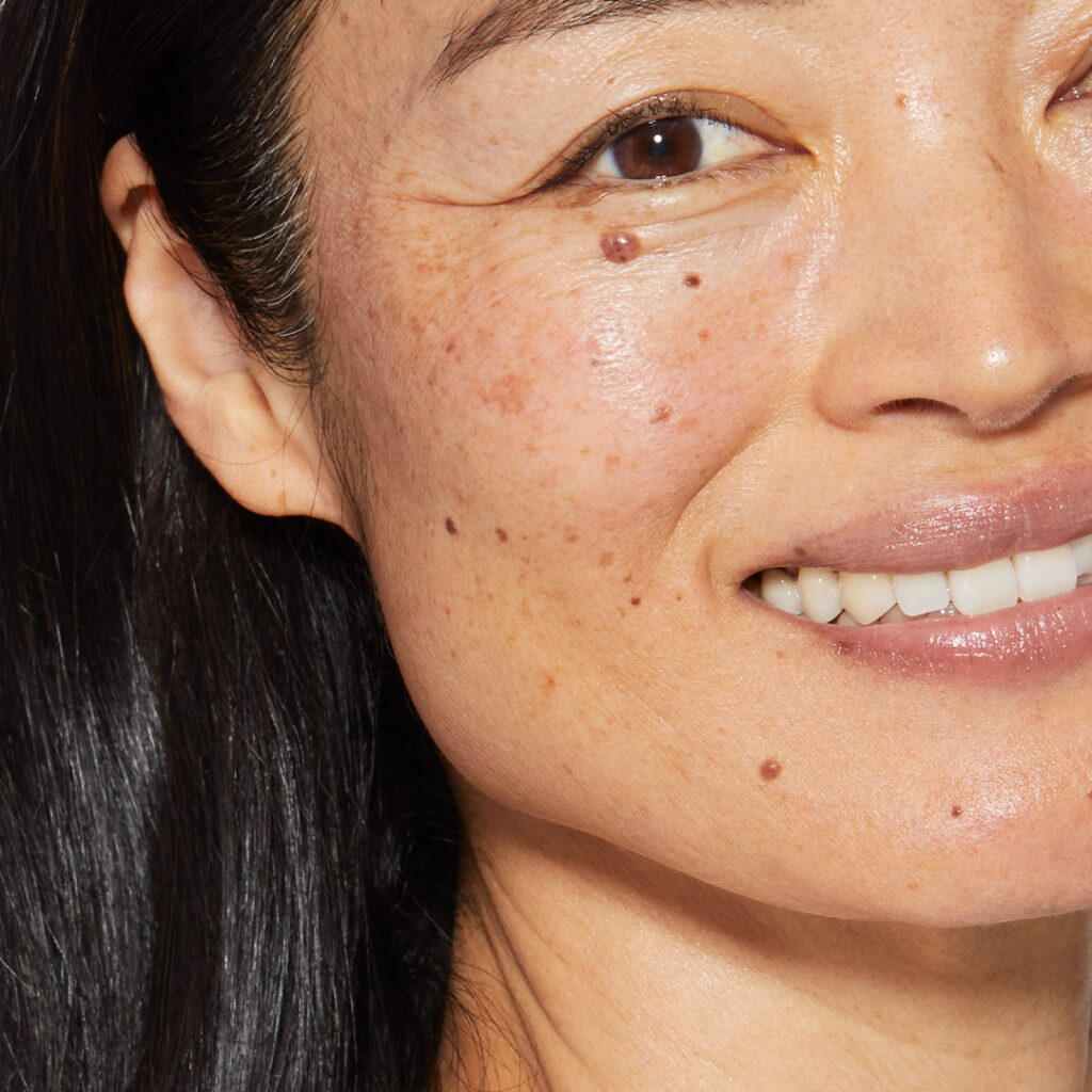 Pigmentflecken und Melasma behandeln bei BellaFrieda Beauty in Berlin Prenzlauer Berg