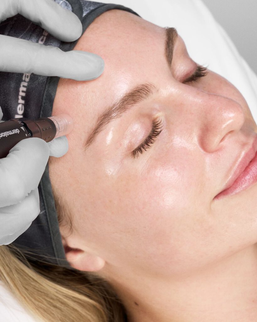 Microneedling zur Hautregeneration bei BellaFrieda Beauty in Berlin Prenzlauer Berg