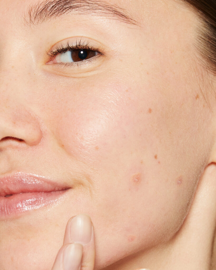 Akne und unreine Haut behandeln bei BellaFrieda Beauty in Berlin Prenzlauer Berg